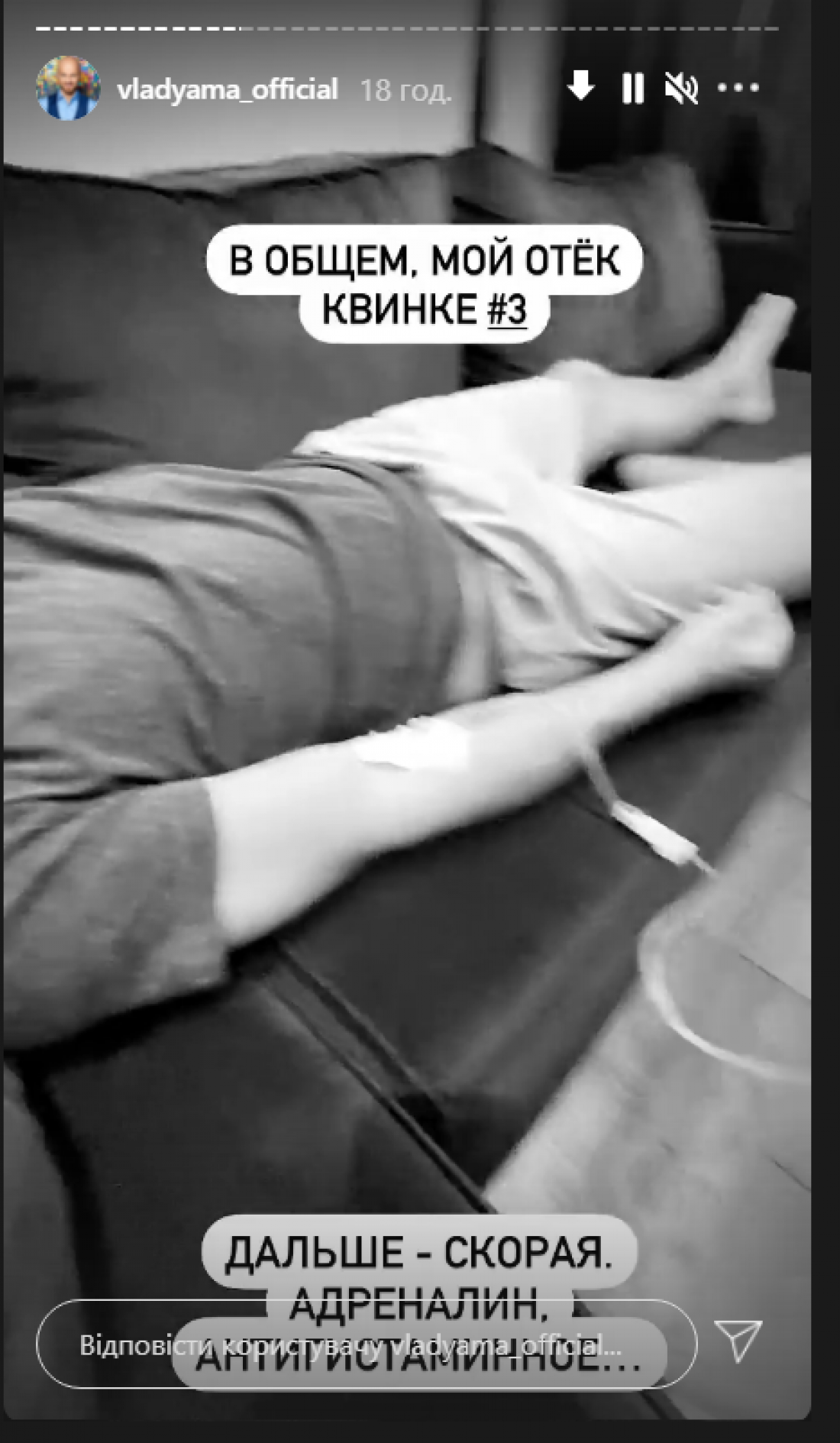 У Влада Ямы случился отек Квинке