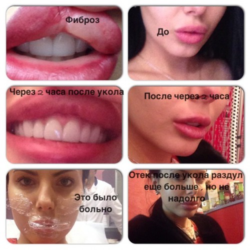 Что бывает от уколов красоты