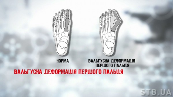 Как лечить косточки на ногах в домашних условиях