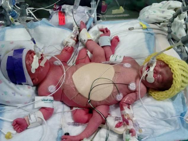Среди новорожденных тройняшек две оказались сросшимися близнецами