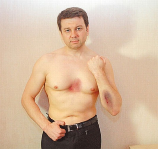 Фото Тимофея Нагорного якобы после избиения охранником Лилии Подкопаевой
